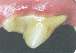 Early Periodontal Disease